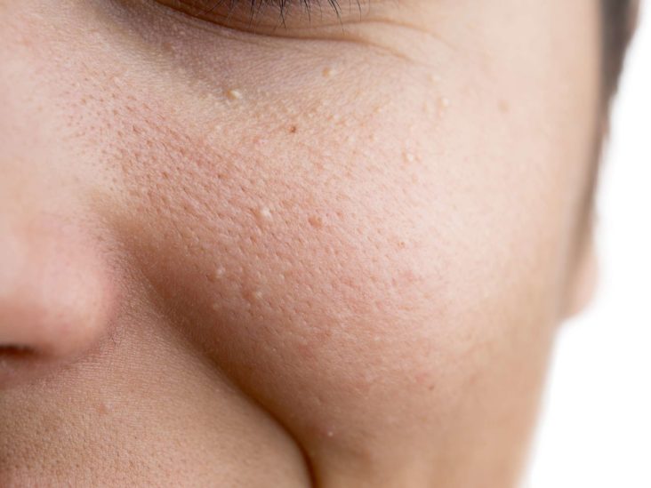 How to get rid of small acne bumps on the face? TT Bicargo