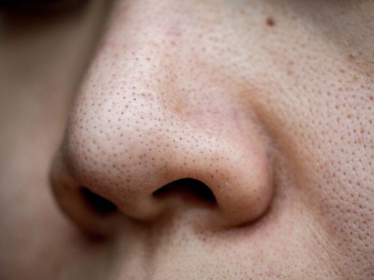 blackheads look like 768x576