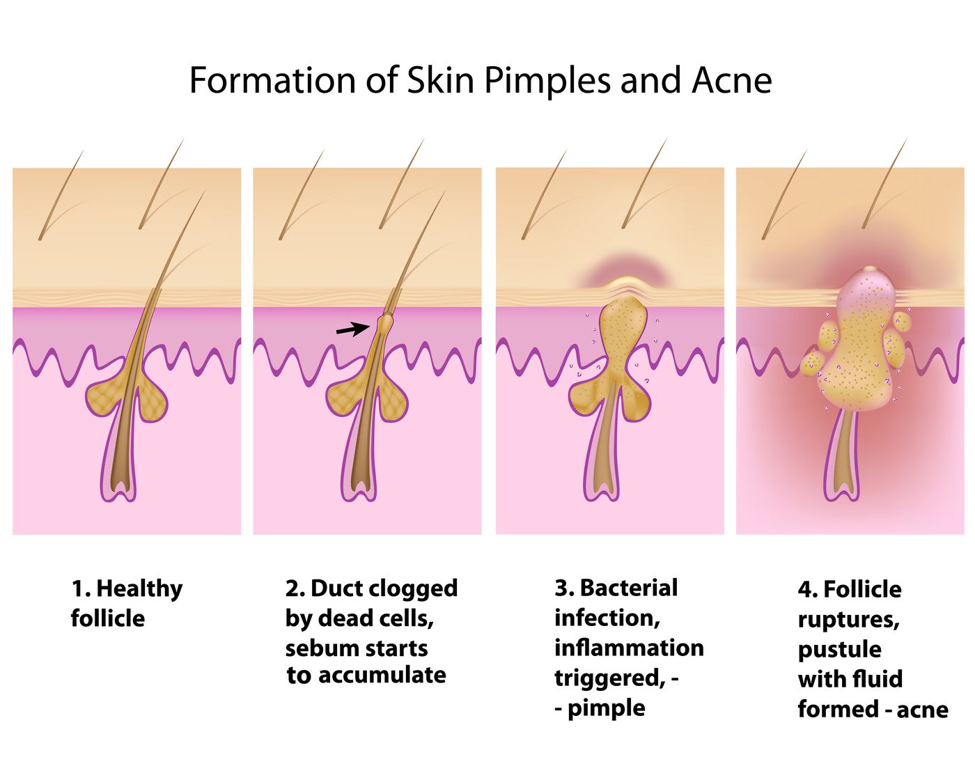 How do pimples form? – TT Bicargo